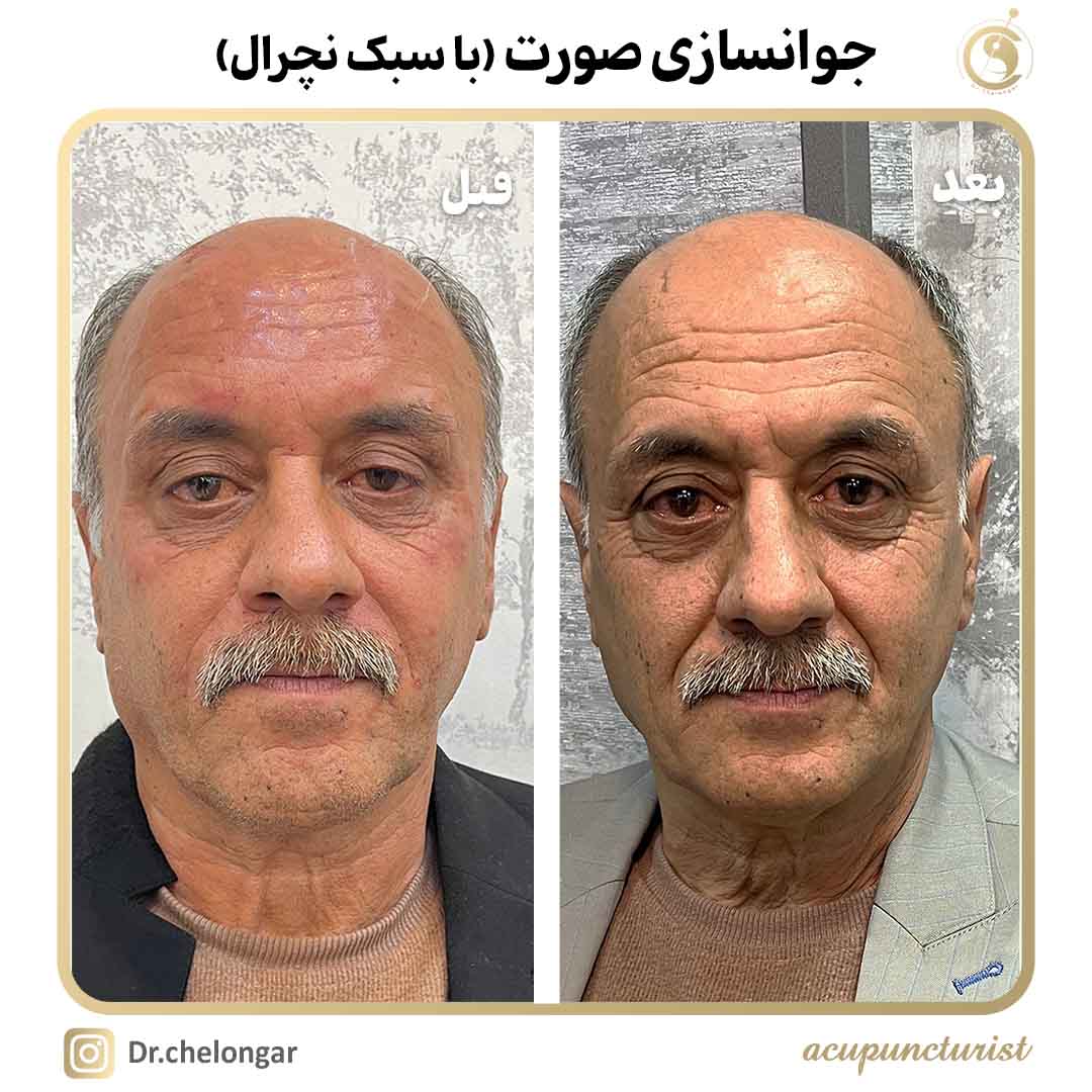 دکتر محمدرضا چلونگر 26 جوانسازی صورت 4
