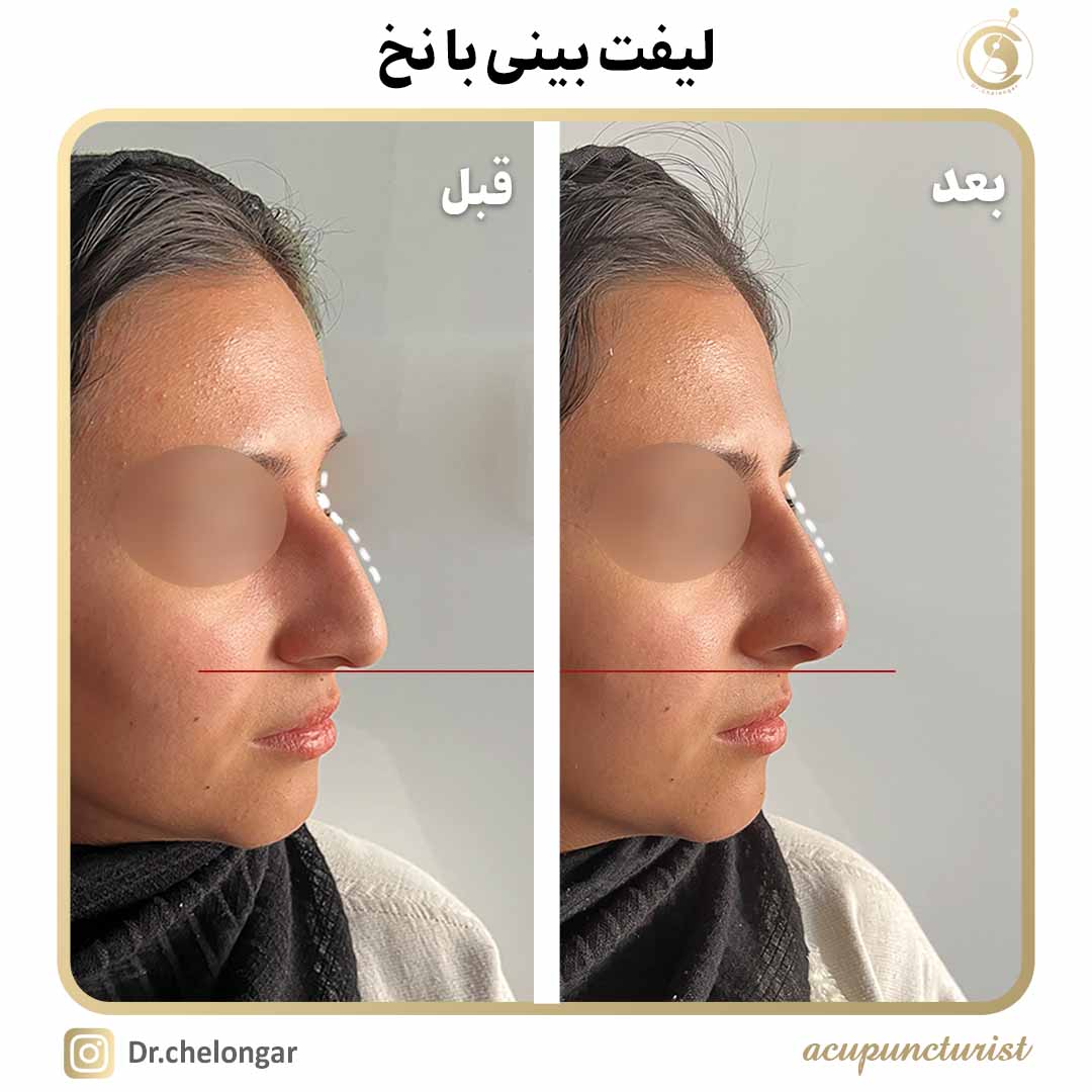 دکتر محمدرضا چلونگر 18 سیات2لیفت بینی