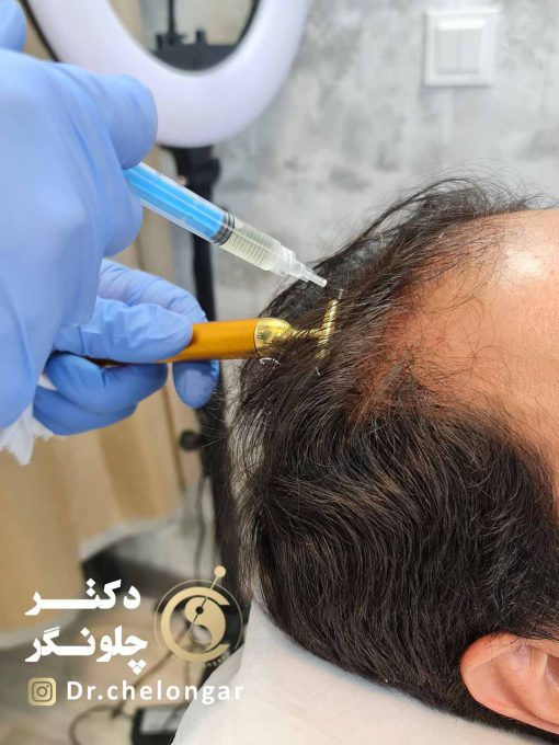 مزوتراپی مو بدون درد